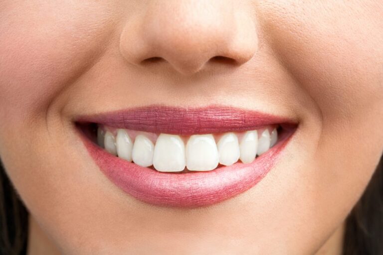Close-up of a smiling woman showing bright white teeth after whitening treatment