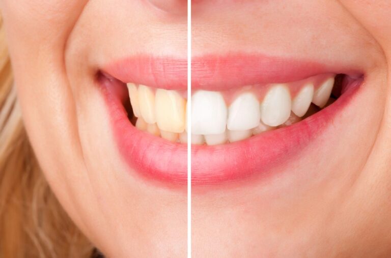 Close-up of a smile showing teeth whitening results, with one side yellow and the other side white