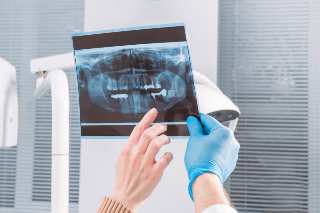 Dentist in Leduc reviewing a wisdom teeth x-ray with a young adult patient before extraction